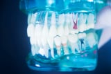 Zubní implantát | Zubní ordinace Blankdent