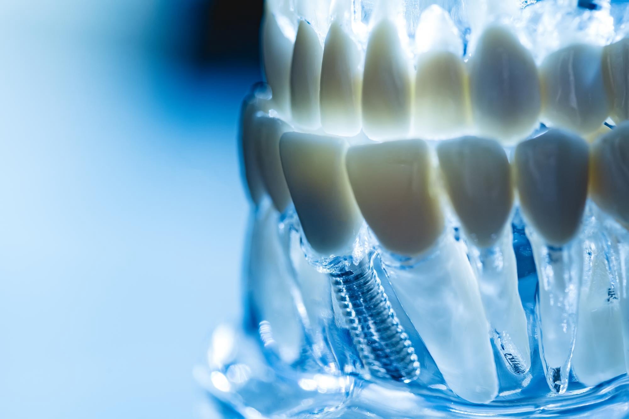 Zubní implantáty | Zubní ordinace Blankdent